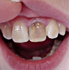 Внутрикоронковое отбеливание зуба