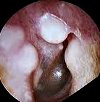 Удаление остеомы или экзостозов наружного слухового прохода