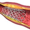 Ангиопластика подколенной артерии