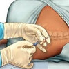 Спинальная анестезия при оперативном родоразрешении
