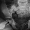 Рентген тазобедренных суставов ребенку