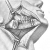 Резекция нижней челюсти
