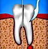 Гемисекция зуба