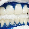 Отбеливание зубов Amazing white