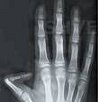 Рентген пальцев руки