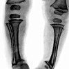 Рентген трубчатых костей ребенку