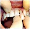 Восстановление коронковой части зуба