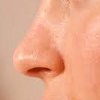 Фракционное омоложение носа