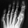 Рентген пальцев ноги