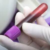 Анализ крови на СА 242 (онкомаркер)