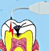 Электроодонтодиагностика зуба
