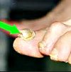 Хирургическое удаление грибкового ногтя