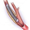 Ангиопластика берцовой артерии