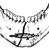 Остеосинтез нижней челюсти