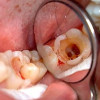 Лечение пульпита молочных и постоянных зубов у детей